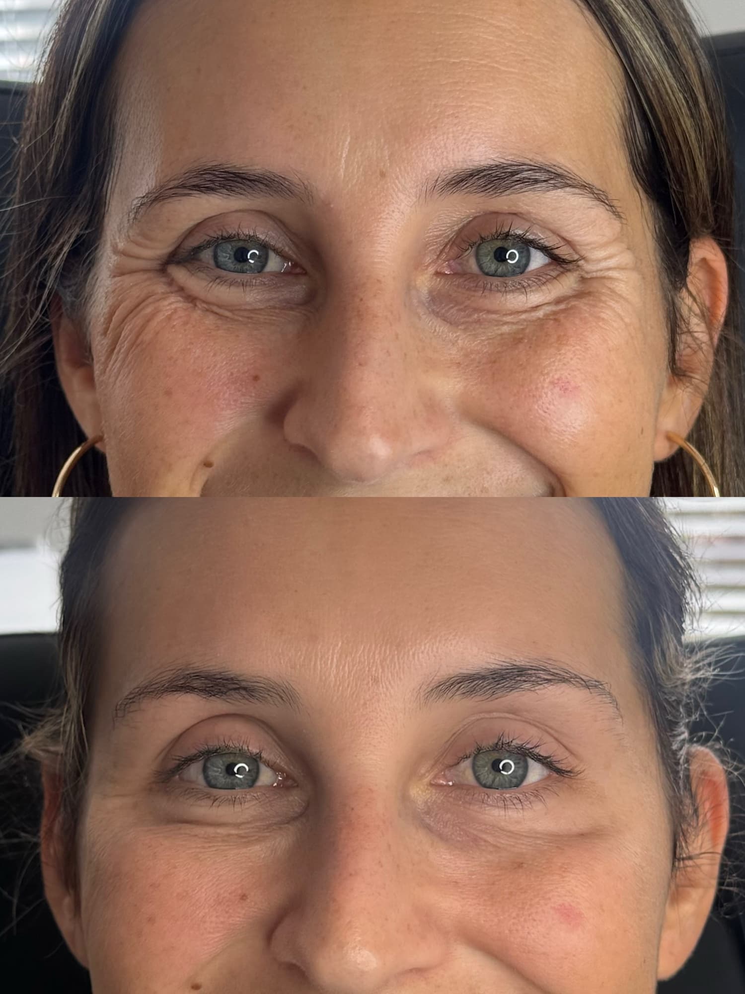 Anti wrinkle before and after