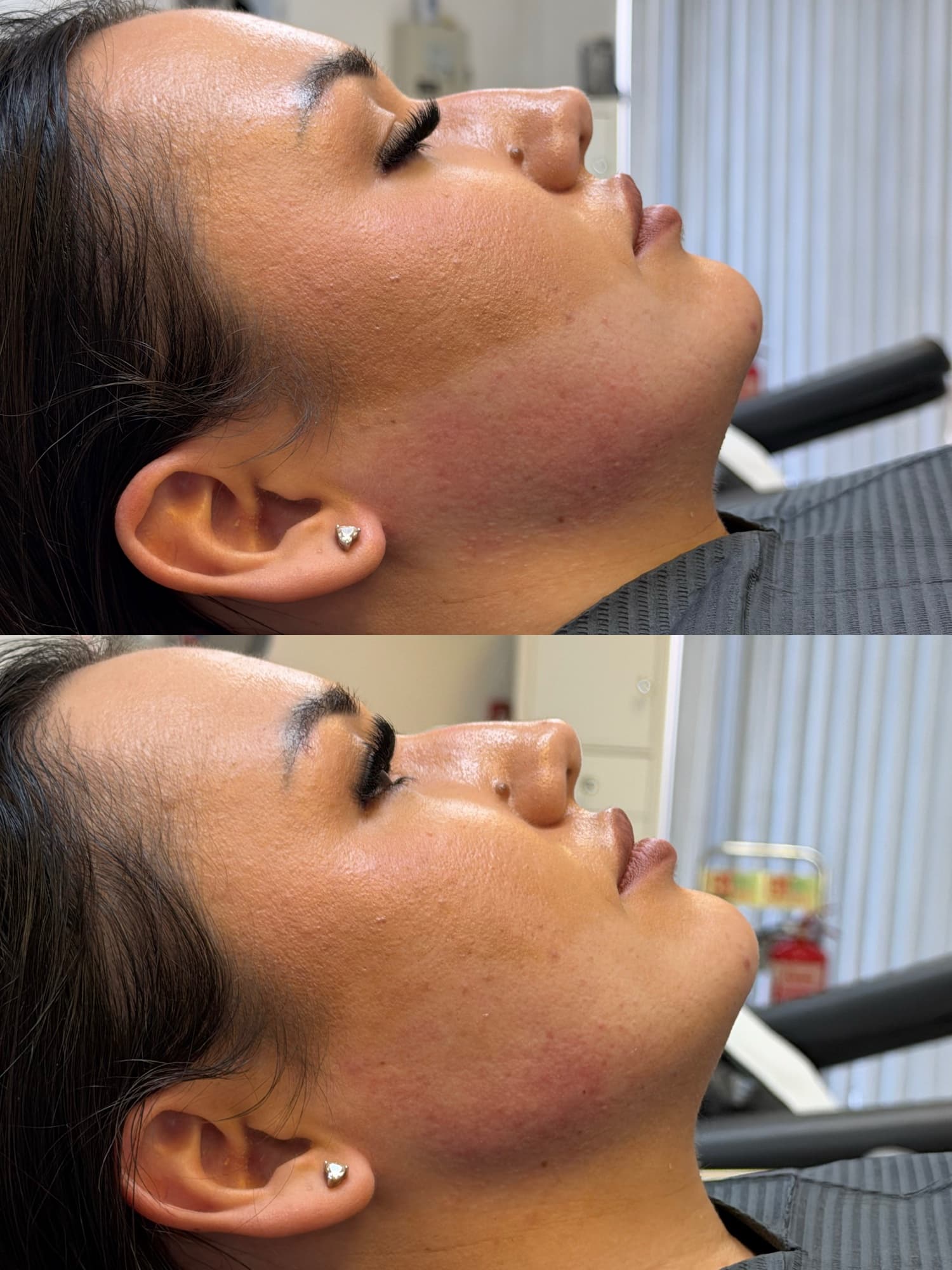 Jawline filler before and after