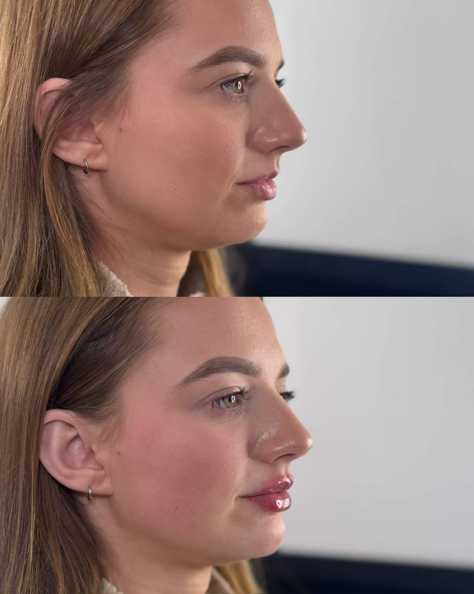 Lip and chin filler before and after