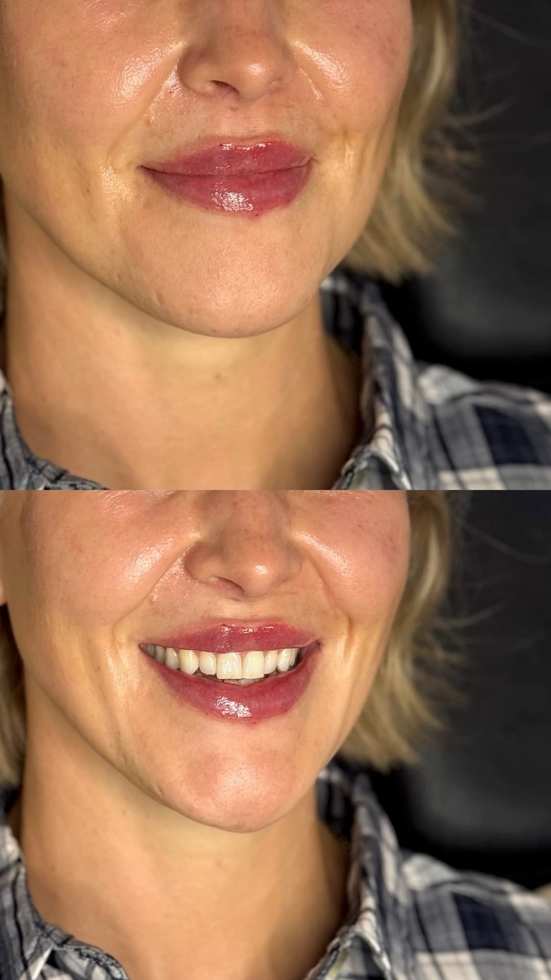 Lip filler before and after