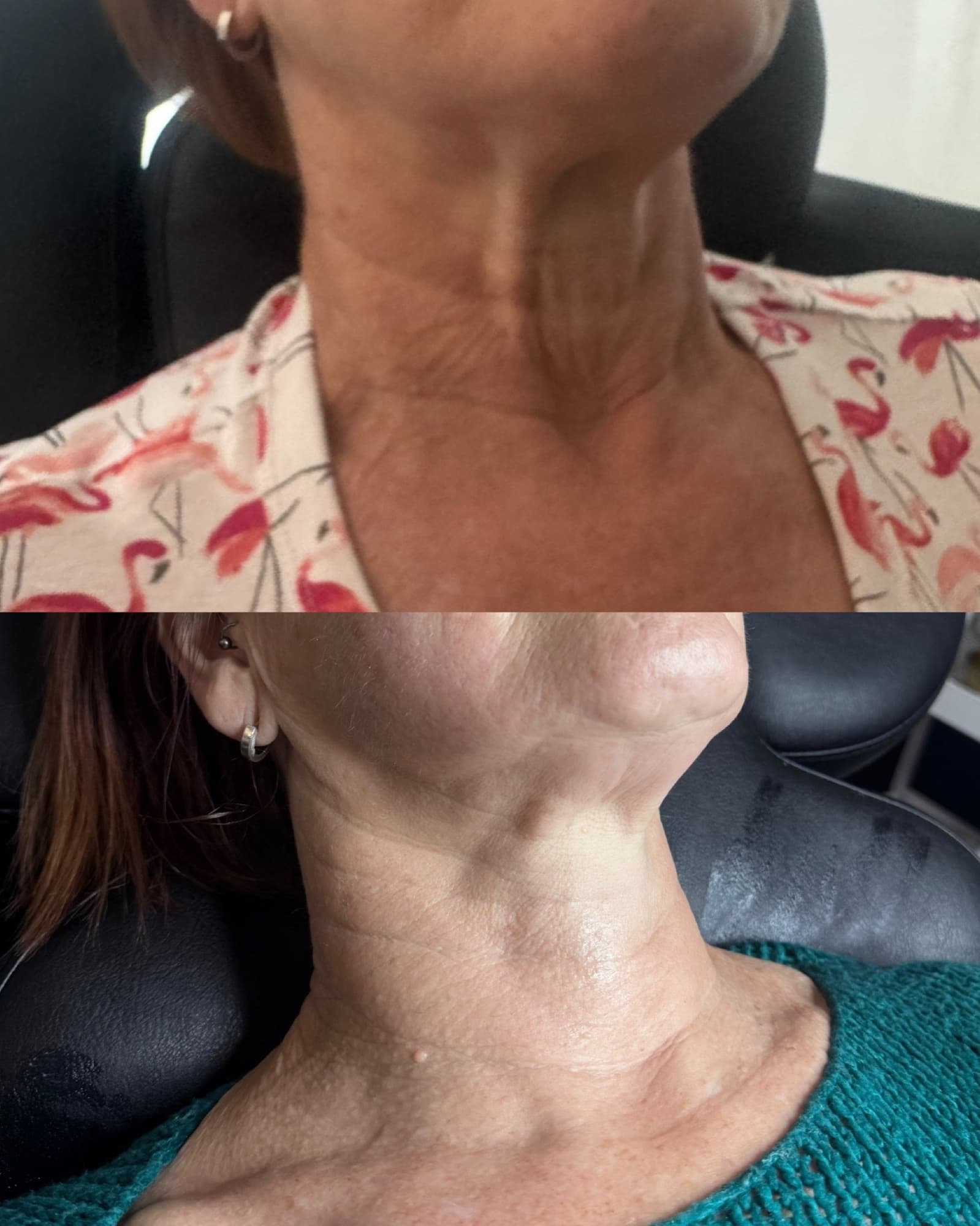 Radiofrequency skin tightening before and after