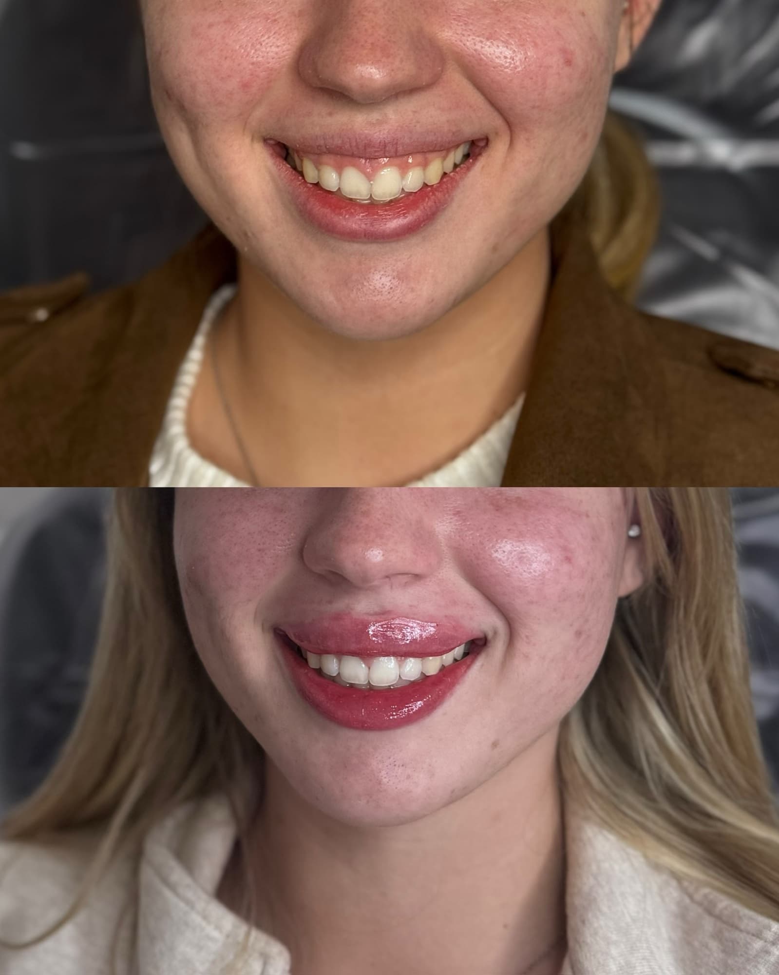Lip flip and lip filler before and after