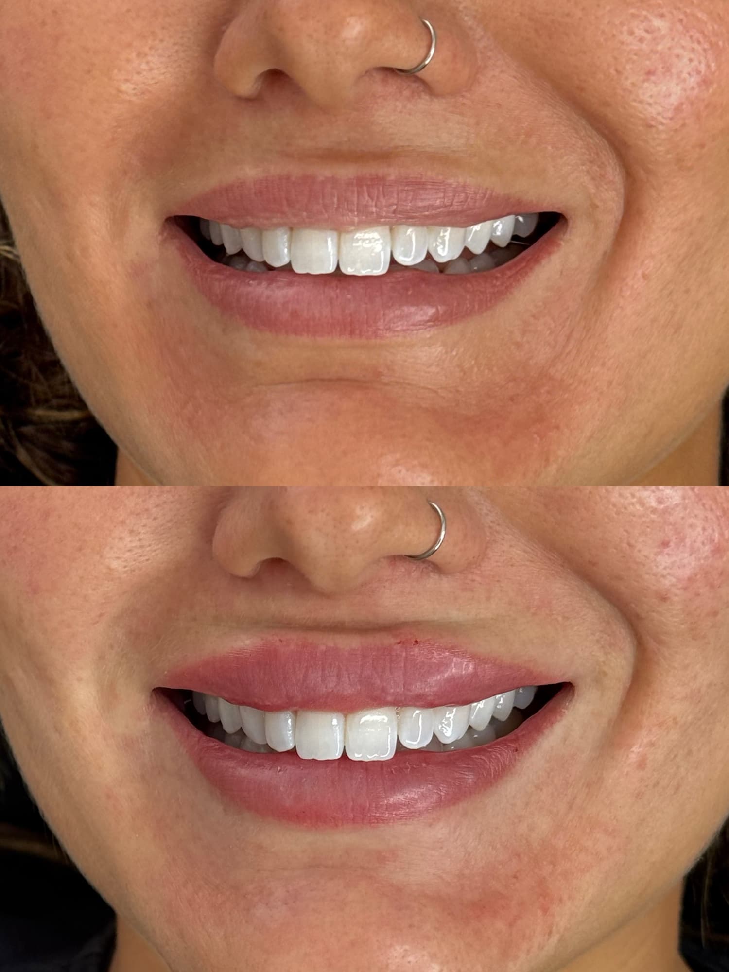 Lip filler before and after
