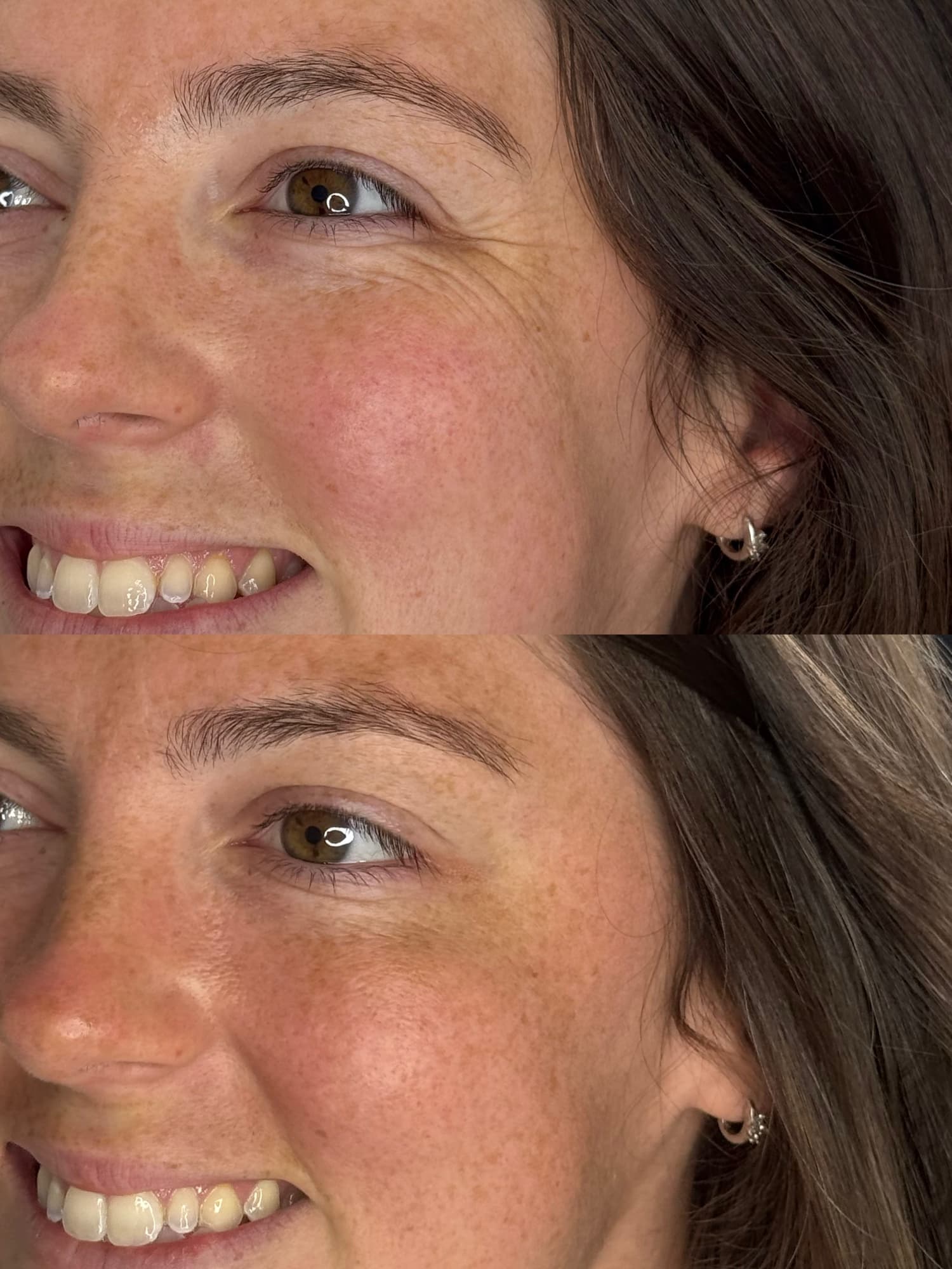 Anti wrinkle before and after