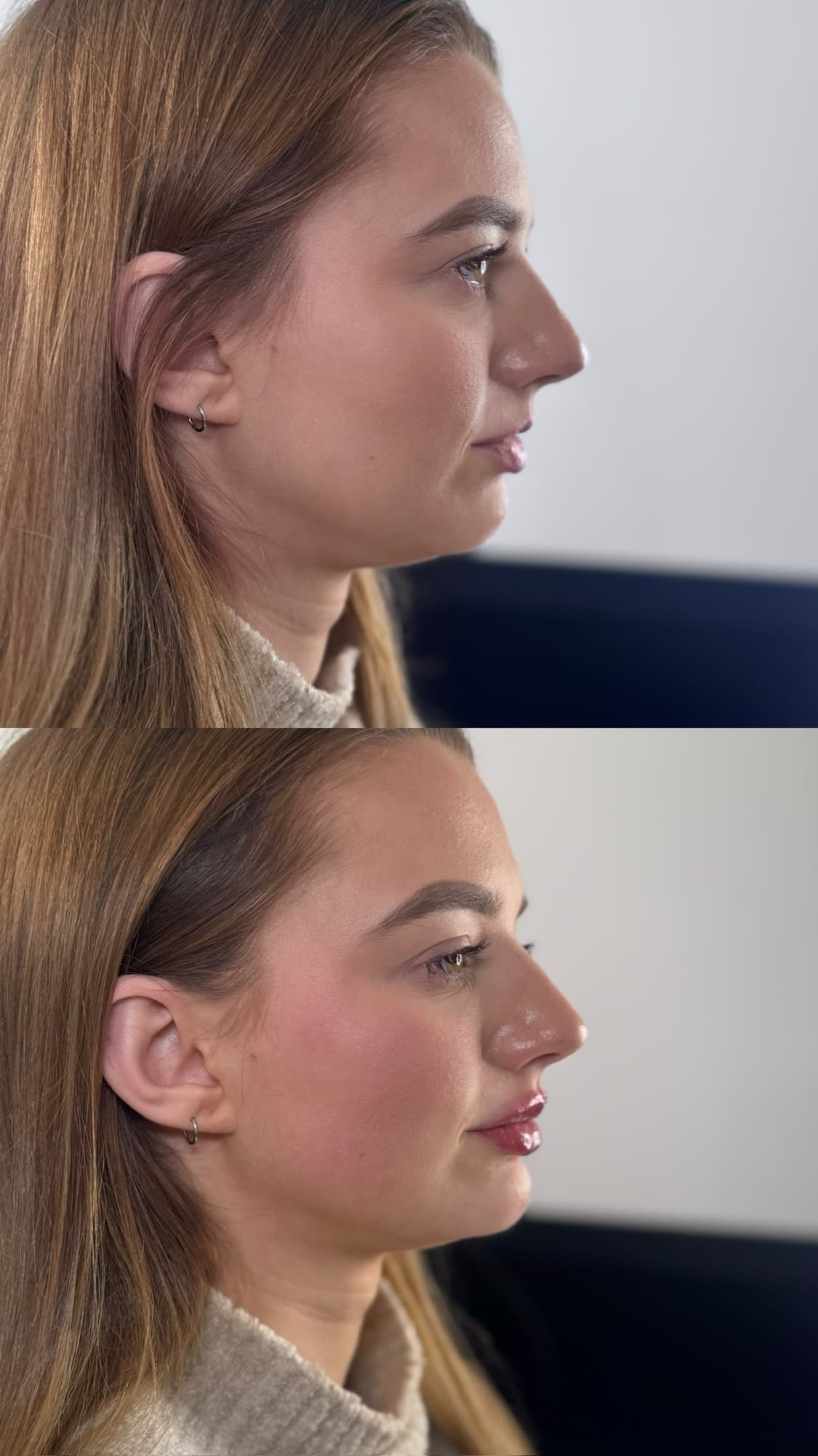 Lip and chin filler before and after