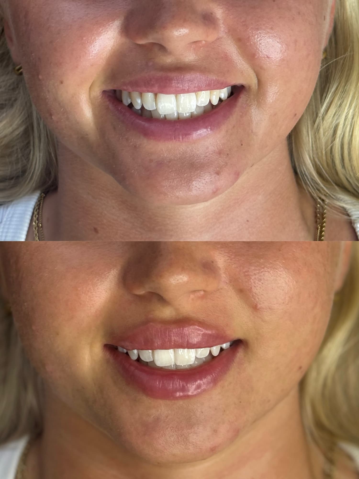Lip filler before and after