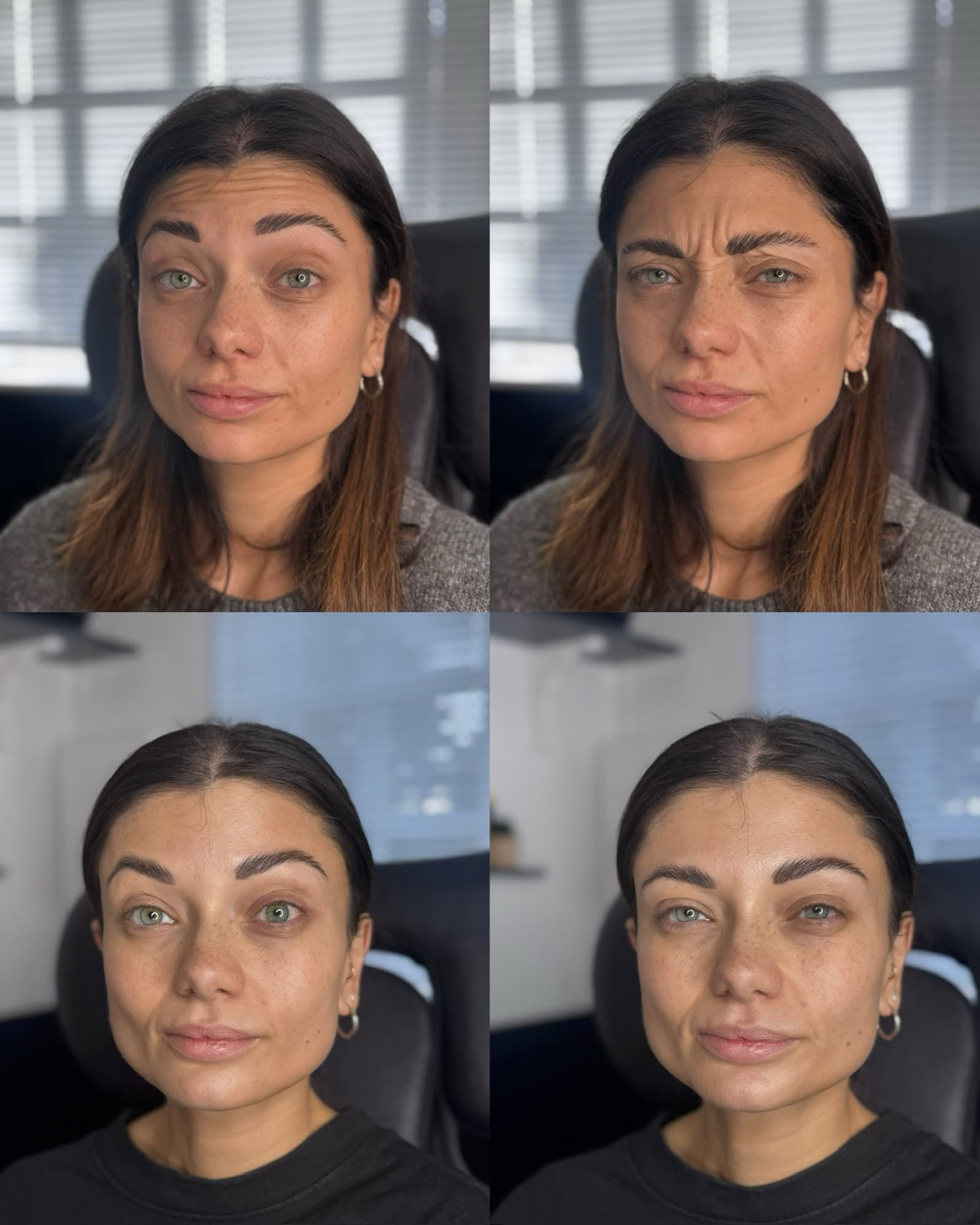 Anti wrinkle before and after