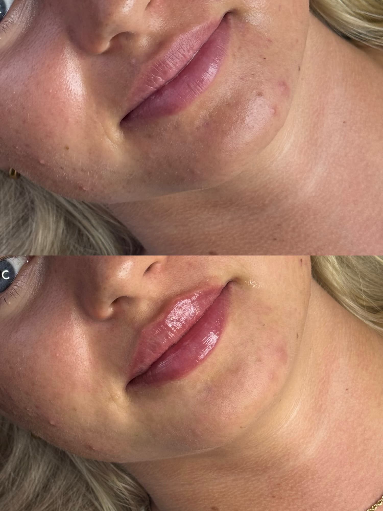 Lip filler before and after