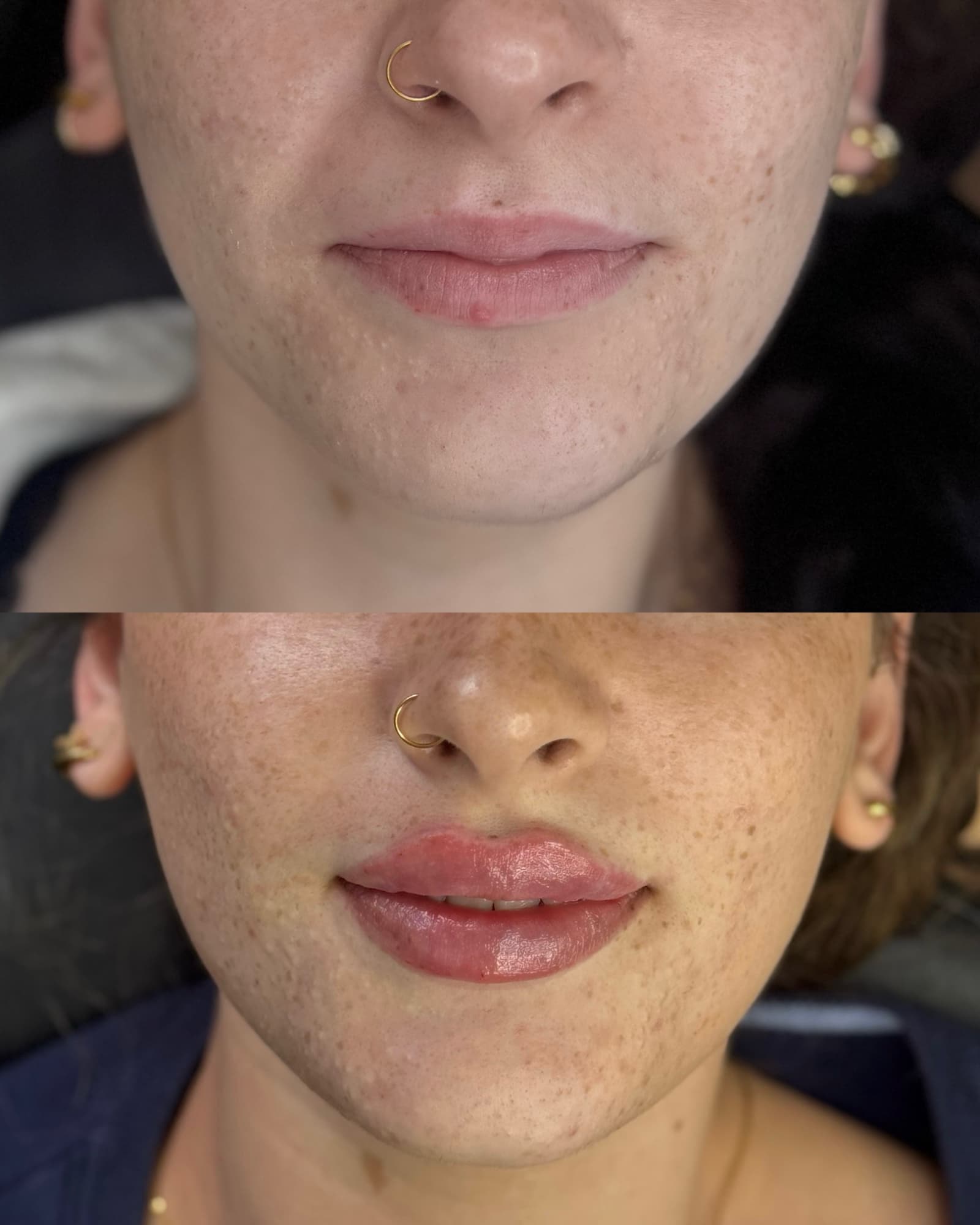 Lip filler before and after