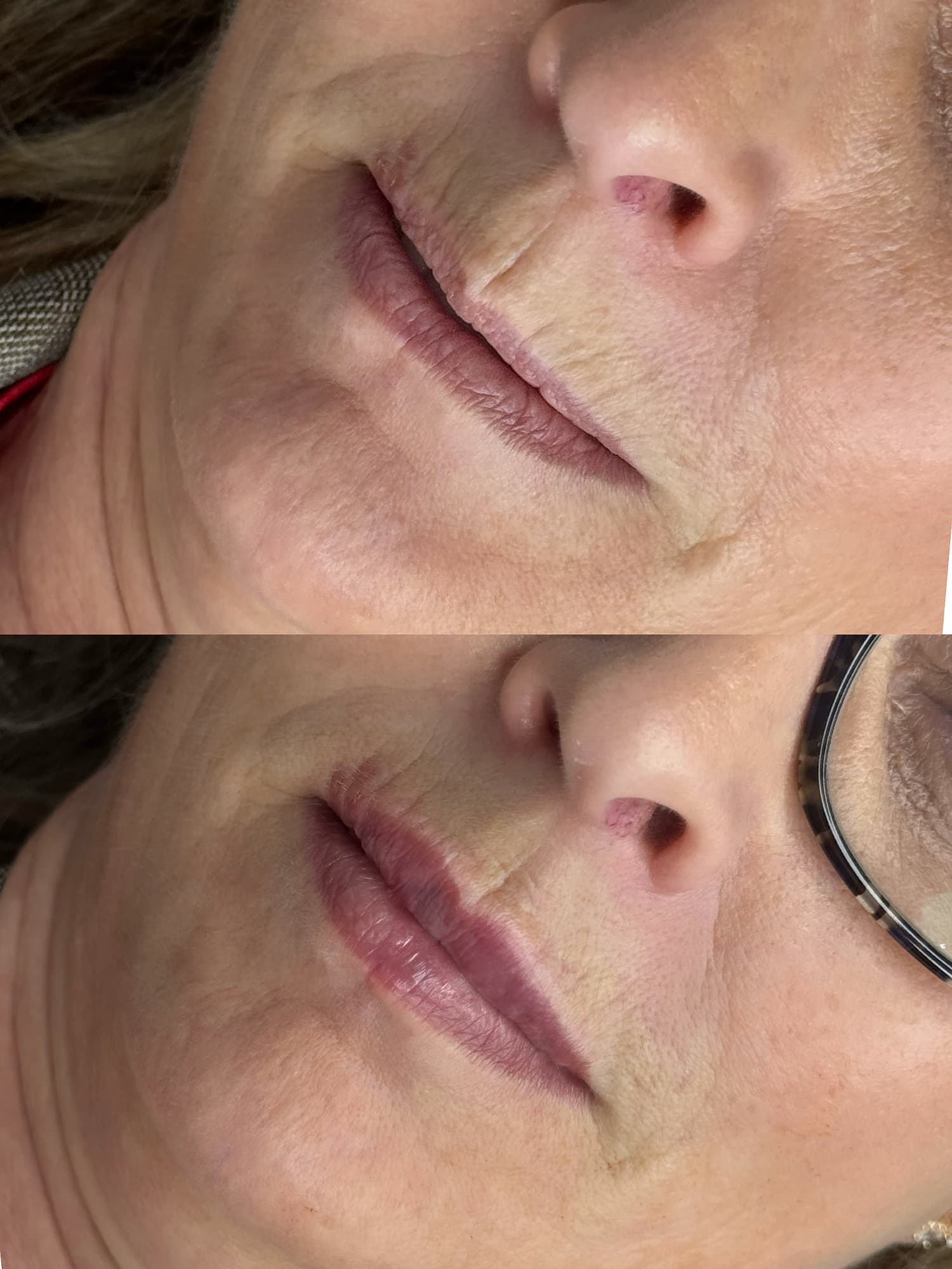 Lip filler before and after