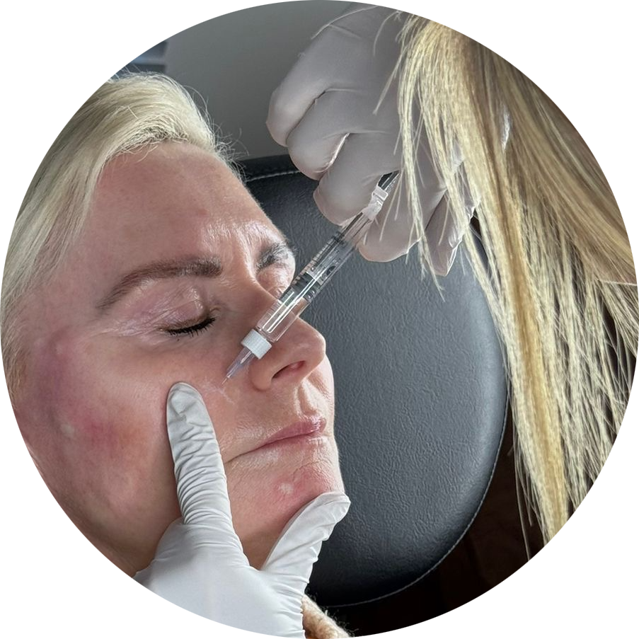 Cheek Filler Treatment at The Aesthetic Touch